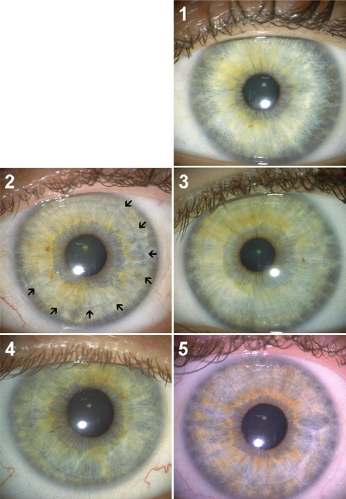 contraction of iris