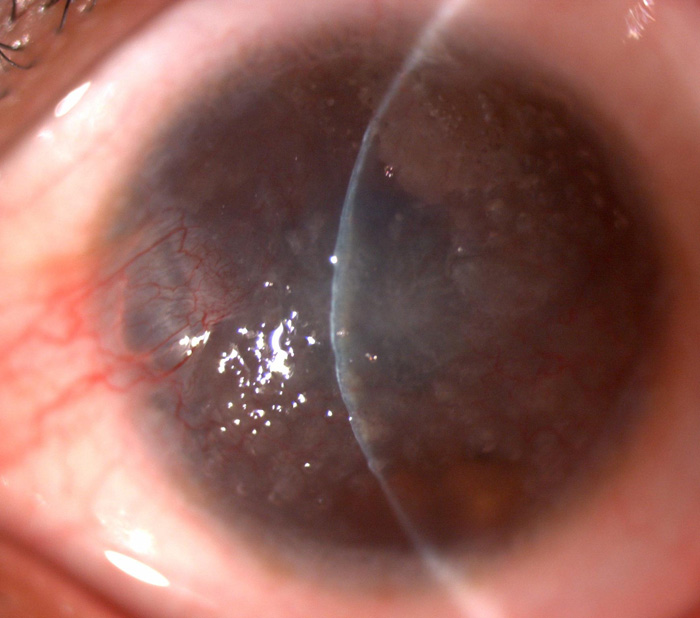 Corneal Opacity