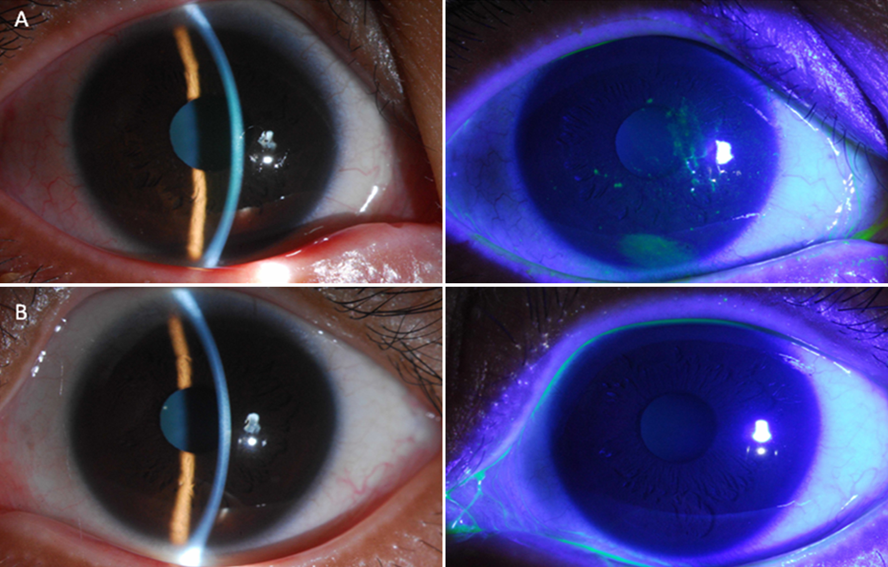 Corneal Abrasion Fluorescein Slit Lamp Corneal Abrasion Fluorescein Slit Lamp