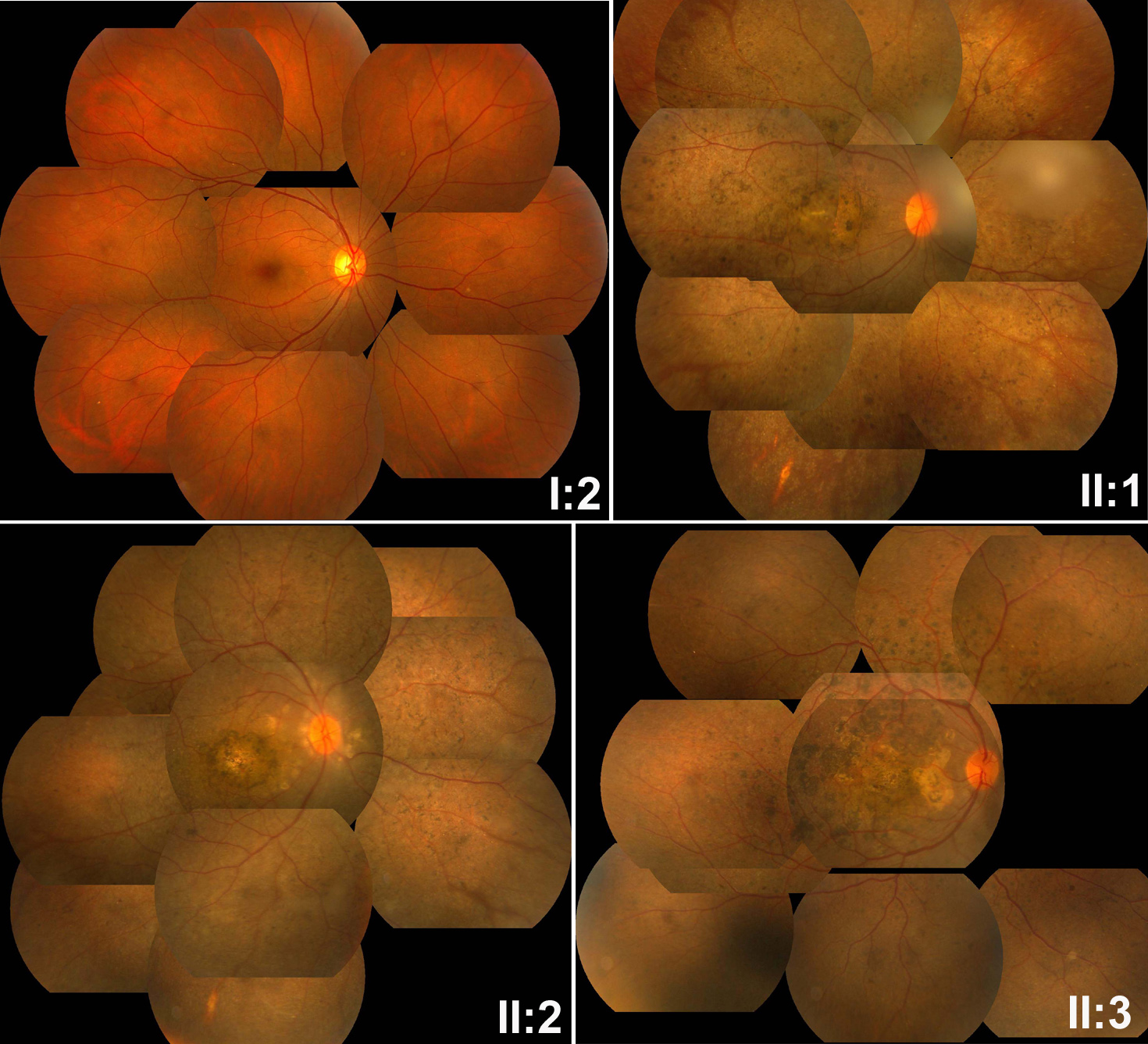 Pale Optic Disc