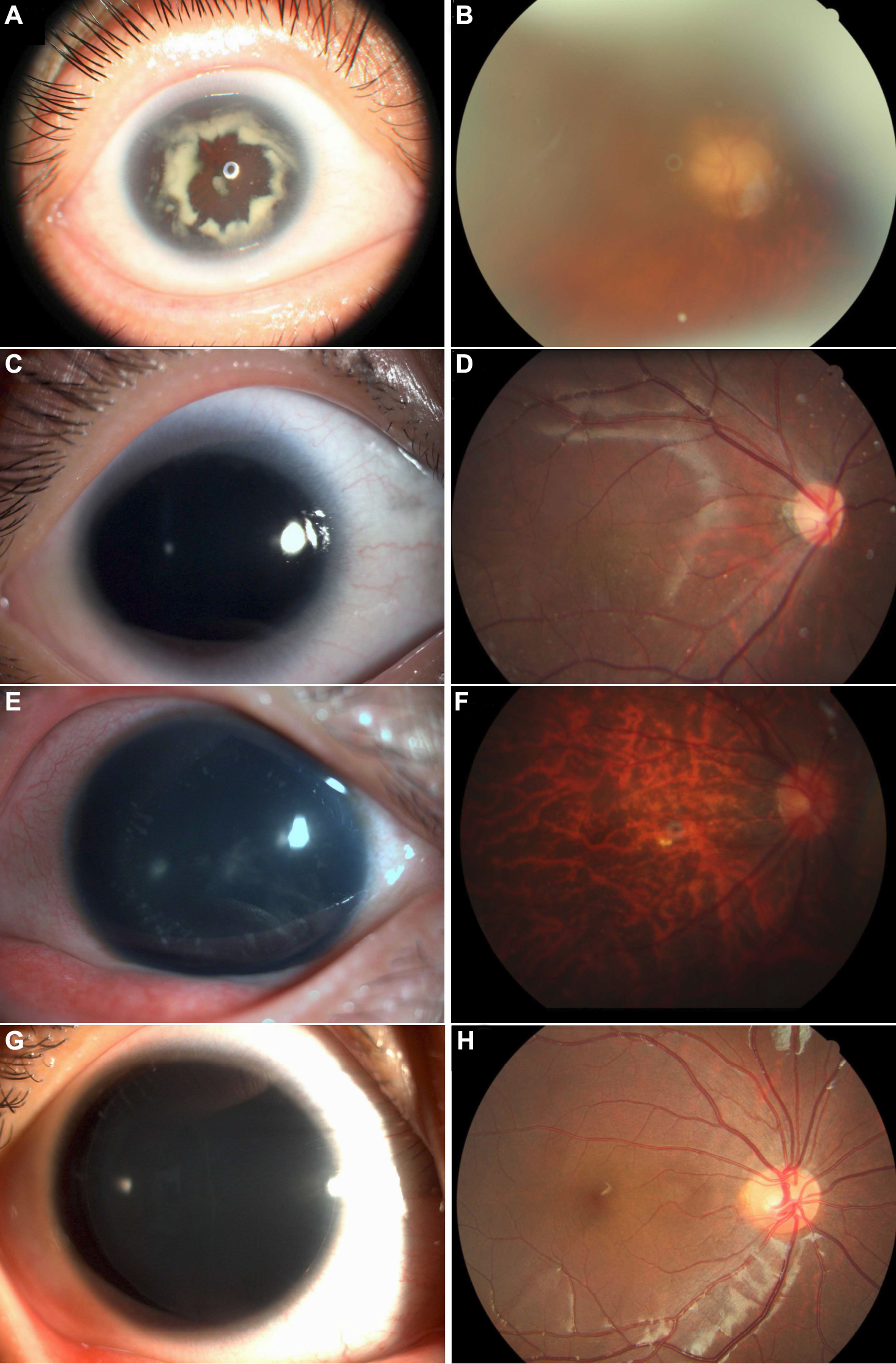 Anterior Fundus