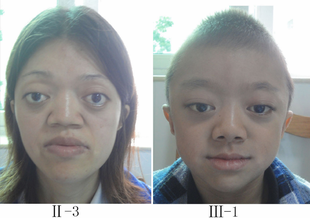 Facial Hypoplasia 106