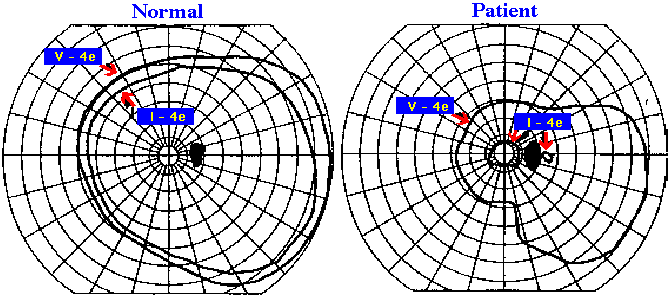  Kinetic perimetry