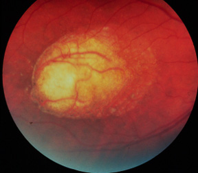 Fundus photograph, individual #3030, right eye